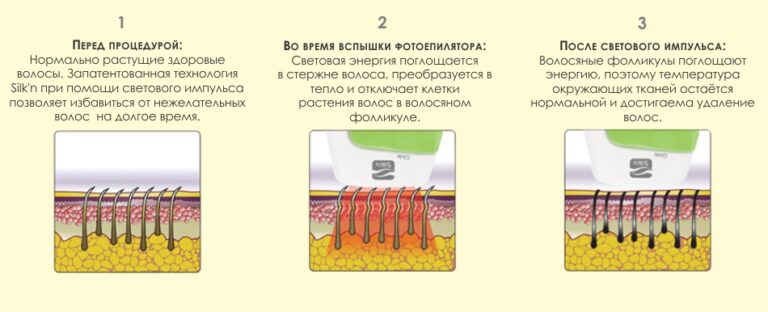fotoepilyatsiya-v-domashnih-usloviyah-realnost